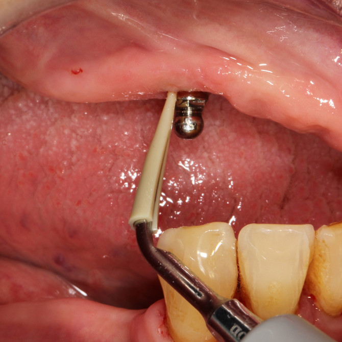 Scorpion Universal Scaler insert-i – Bild 8