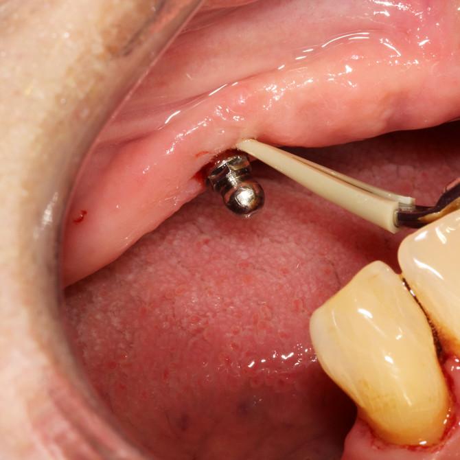 Scorpion Universal Scaler insert-i – Bild 7