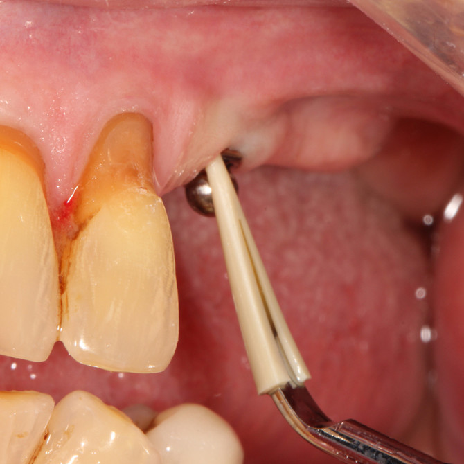 Scorpion Universal Scaler insert-i – Bild 6