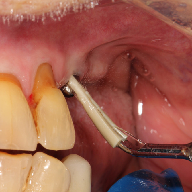 Scorpion Universal Scaler insert-i – Bild 5